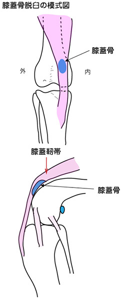 膝蓋骨脱臼の模式図