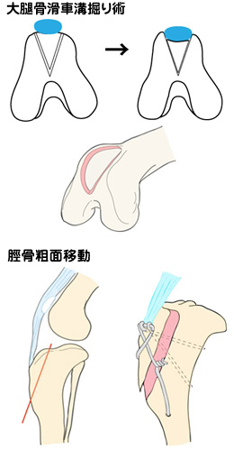 膝蓋骨脱臼の模式図